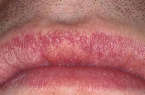 Fordyce Spots Causes Symptoms Treatment Home Remedies Pictures Healthmd