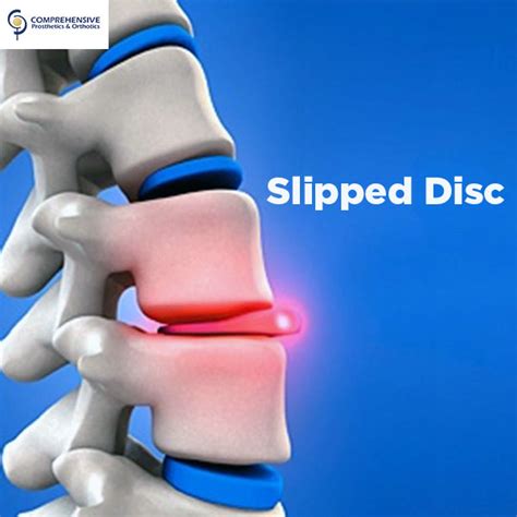 The pain is no better after a month. Slipped Disc | Prosthetics & Orthotics | CPO