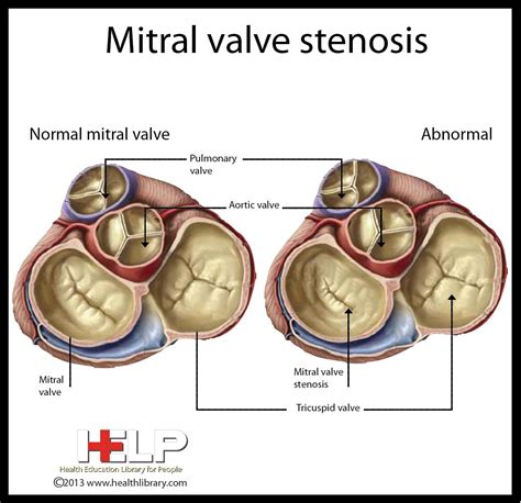 Mitral Valve Stenosis Dyspnea Fatigue Orthopnea La P Overload La
