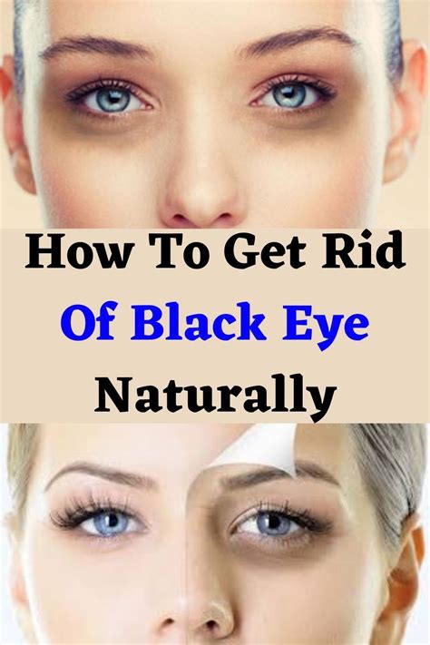 How To Get Rid Of Black Eye Naturally In 2021 Eye Black Eye