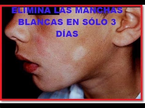 Cara manchas piel cara manchada mujer manchas manchas piel manchas por sol en la cara manchas blancas en la cara manchas de sol pecas manchas en la cara manchas faciales. Manchas Blancas En La Cara - All You Need Infos