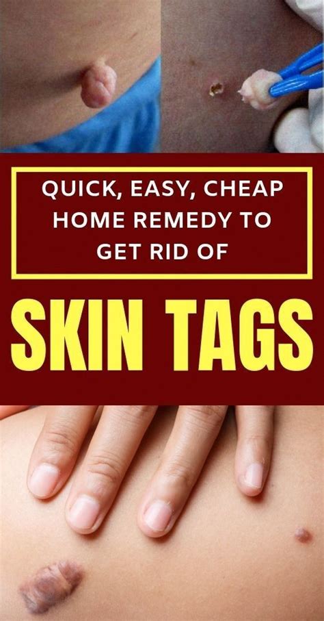 how to remove skin tags naturally natural home remedies for skin tags artofit