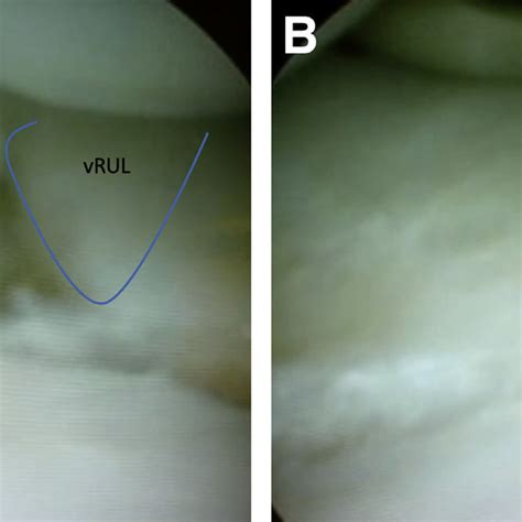Dorsal Intercalated Segment Instability Disi With A Scapholunate