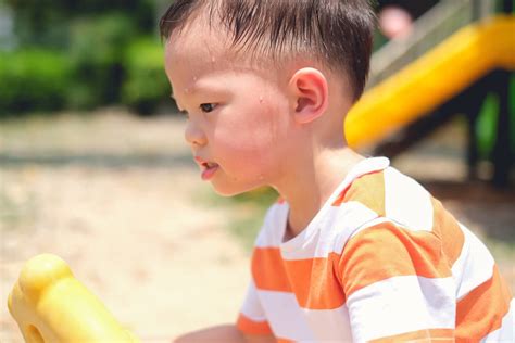 Sunburn In Children Why Is It So Dangerous