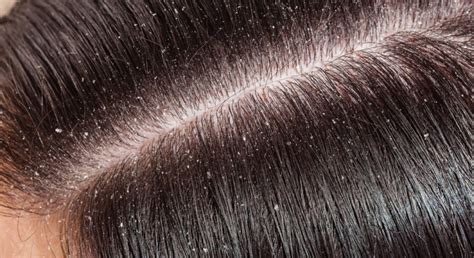 Know The Difference Dandruff Vs Dry Scalp
