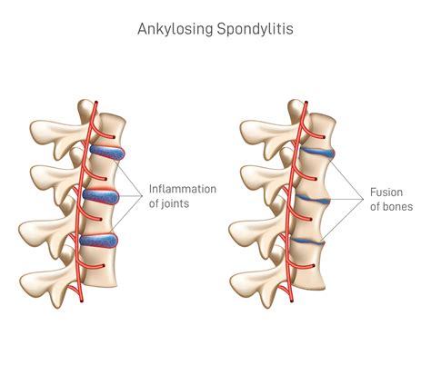 Spondylitis Of The Spine