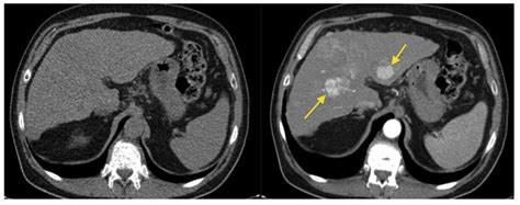 Both give good pictures but if you have any metal in your body, (such as a hip replacement) you cant have an mri. Contrast Scans - MRI (or) CT - 9 Things you should know!