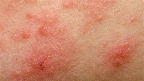 Allergic Eczema Causes Symptoms And Diagnosis Eczema Symptoms