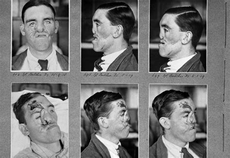 Lest We Forget Remembering Wwi Plastic Surgery Pioneers