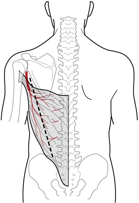 Technique For Using Pedicled Latissimus Dorsi Muscle Flaps To Wrap
