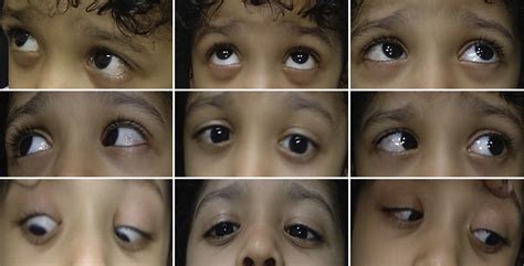 Pattern Strabismus In Consecutive Esodeviation After Bilateral Lateral Rectus Muscle Recession