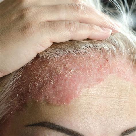 Scalp Psoriasis Home Remedies And Tips For Relief Forces Of Nature