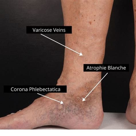 When Should I See A Doctor About My Varicose Veins The Veincare Centre