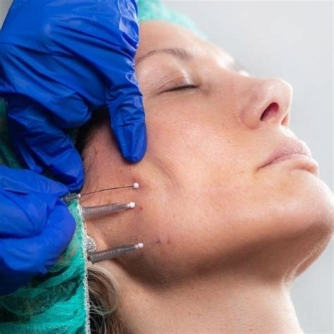 Non Surgical Thread Lift Sydney Look Years Younger Book Now