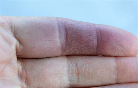 Paroxysmal Hand Hematoma Wikipedia Syndrome De Raynaud Hemorrhage