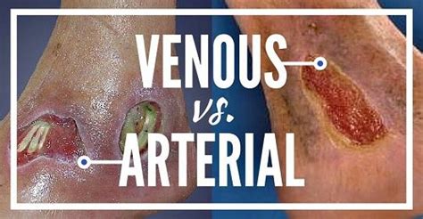 What type of lesion is it? Venous, Arterial or Mixed Ulcer...How Do I Know For Sure ...