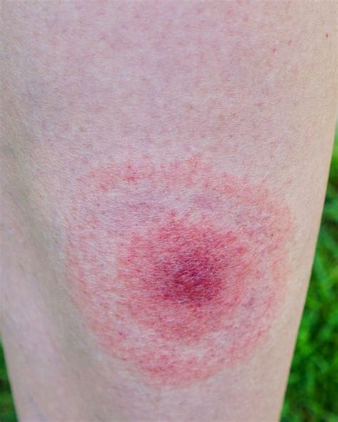 12 Common Bug Bite Pictures How To Id Insect Bites And Stings