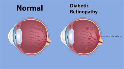What Its Like To Have Diabetic Macular Edema Everyday Health