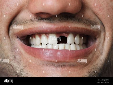Smile Without Front Tooth Hi Res Stock Photography And Images Alamy