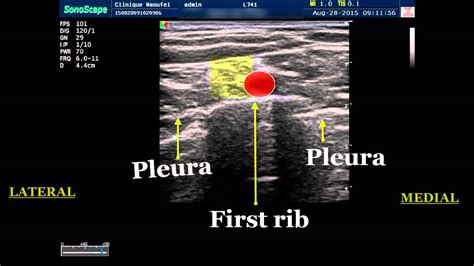 Sonoanatomy Of The Supraclavicular Fossasupraclavicular Block Youtube