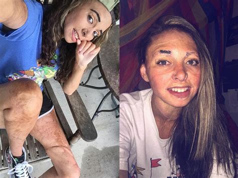 Why This Burn Survivor Is Done Covering Up Her Scars Self