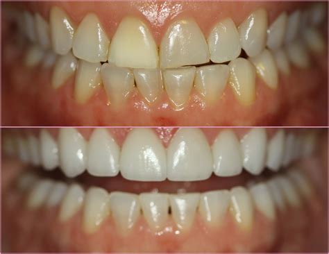Porcelain Veneers Chicago Before And After July Case Of The Month