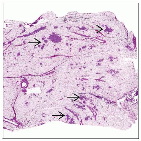 Cystic fibrosis (cf) is a genetic disorder that affects mostly the lungs, but also the pancreas, liver, kidneys, and intestine. Cystic Fibrosis, Pancreas | Basicmedical Key