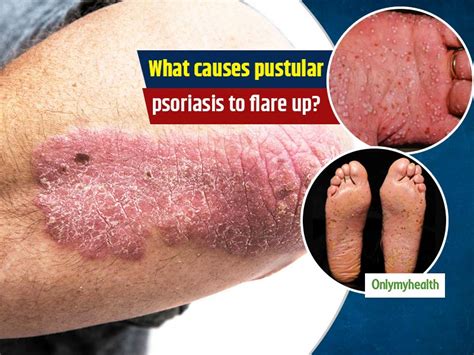 What Is Pustular Psoriasis Types Causes And Treatment What Is