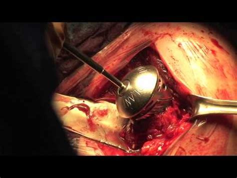 Protesi Frattura Spalla Zimmer - YouTube