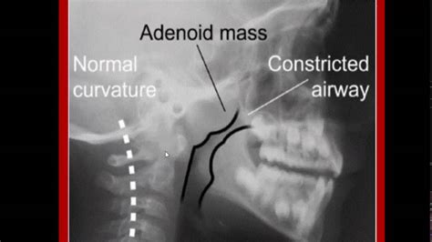 Enlarged Adenoids In Toddlers