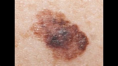 Skin Cancer Stage 2b Cancerwalls
