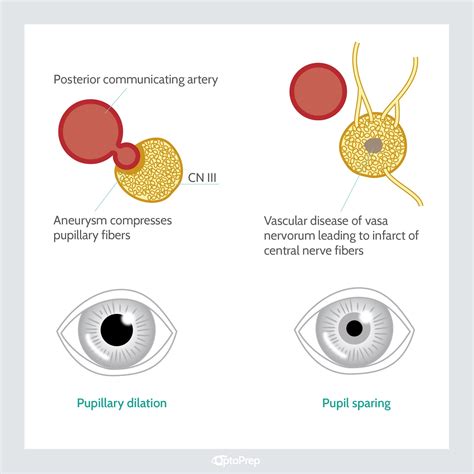 Pupil Involved Vs Pupil Sparing Acquired Oculomotor Nerve Palsy