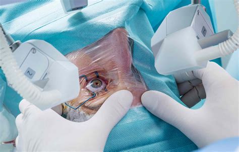 Chirurgie De La Cataracte Au Laser Tout Ce Que Vous Devez Savoir Fmedic