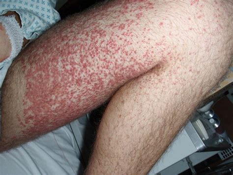 Difference Between Petechiae Purpura And Ecchymosis Compare The