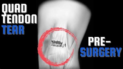 Quadriceps Tendon Tear Pre Surgery What Happened Part 1 Youtube