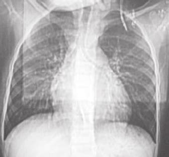 B Anteroposterior X Ray Of The Chest Showing Calcification Of The