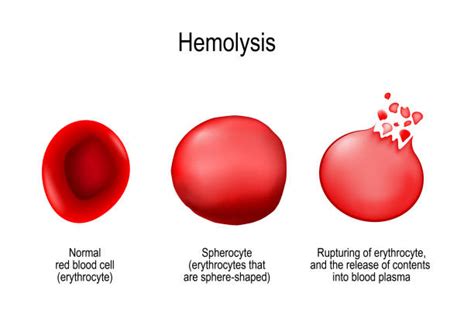 160 Hemolysis Stock Photos Pictures And Royalty Free Images Istock