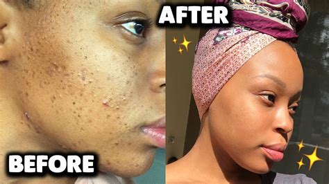 Affordable Skincare Routine For Acne And Dark Markshyperpigmentation