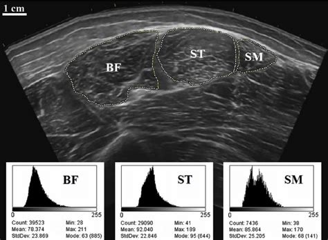 Transverse Plane Panoramic Ultrasound Image Of The Long Head Of The