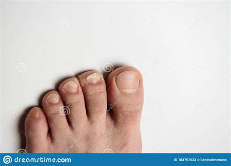 Fungus Infection On Nails Of Man S Foot On White Background Stock Image