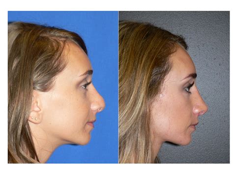 Revision Rhinoplasty The Cure For A Botched Nose Job Rhinoplasty