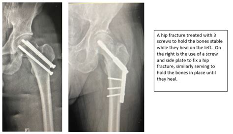 Replacement Surgery For Hip Fractures Hip And Knee Care