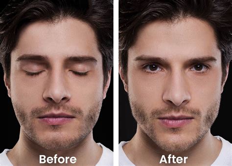 Botox In Jawline Before And After