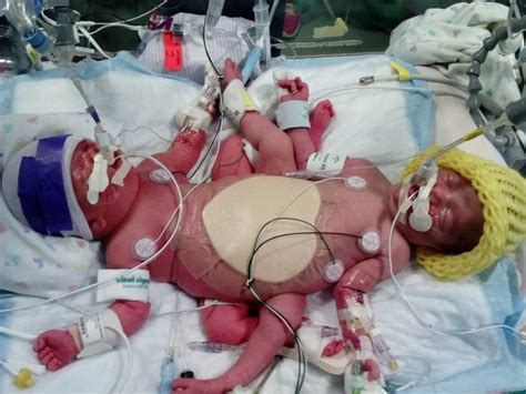 Texas Mom Delivers Conjoined Twins Who Are Also Rare Identical Triplets