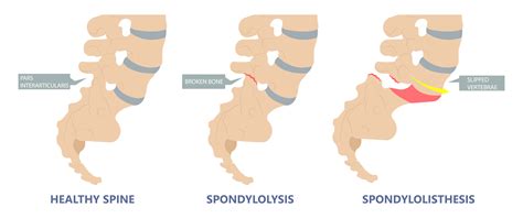 Types Of Spondylosis