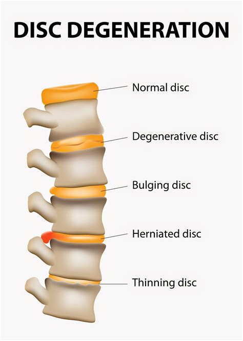 July Focus Spinal Disc Problems The Rivermead Osteopaths