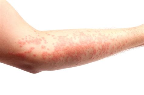Welts Symptoms Causes And Treatment