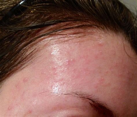 Is This Folliculitis Or Dryitchiy Acne General Acne Discussion