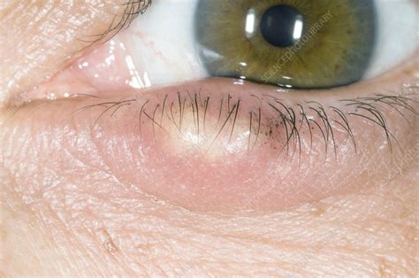 Stye On The Lower Eyelid Stock Image C0085722 Science Photo Library