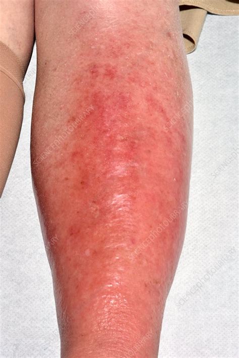 Cellulitis Of The Leg Stock Image C0426406 Science Photo Library